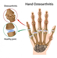 Hand Oesteoarthitis